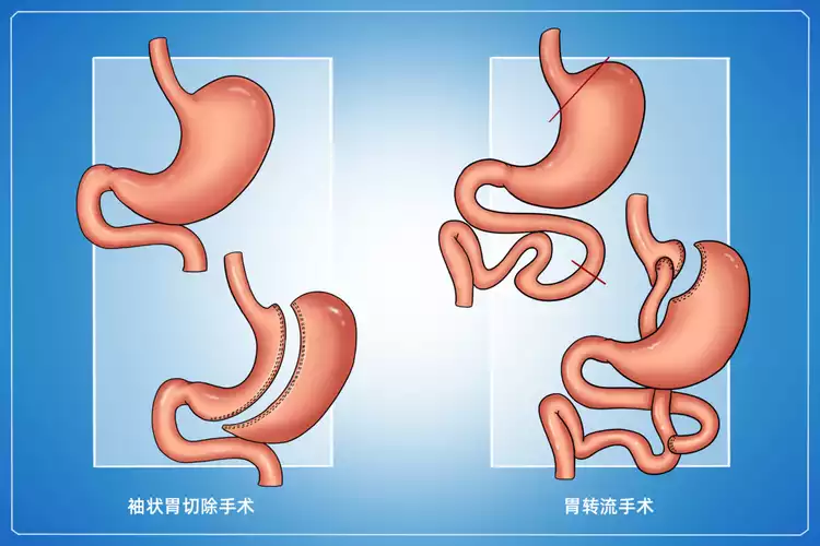 微创缩胃手术：减肥新选择(1)